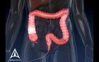 Colonoscopy - 3D Medical Animation