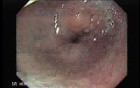 Distal Esophageal Squamous Cell Carcinoma - Endoscopic View
