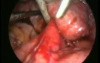 Laparoscopy - Cyst With Non Communicating Horn