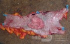 Colon Adenocarcinoma, Villous Adenocarcinoma (7 of 12)