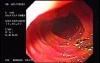 Multiple Duodenal Ulcers (3 of 3)
