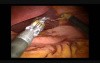 Nissen Fundoplication