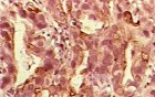 Barrett Adenocarcinoma - Endoscopic Image (9 of 20)