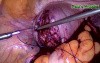 Laparoscopic Excision of Leiomyomas