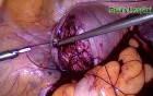 Laparoscopic Excision of Leiomyomas