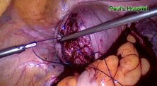 Laparoscopic Excision of Leiomyomas