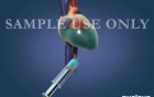 Pericardiocentesis Without Heartbeat - Blue Fluid