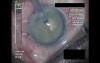 Cataract Surgery VIII - Part 1
