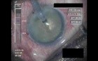 Cataract Surgery VIII - Part 1
