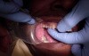 Empress CAD Crown Before Cementation