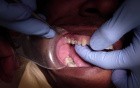 Empress CAD Crown Before Cementation