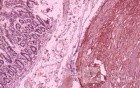 Jejunal Gastrointestinal Stromal tumor (GIST) (13 of 86)