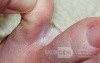 Interdigital Tinea pedis
