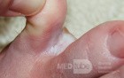 Interdigital Tinea pedis
