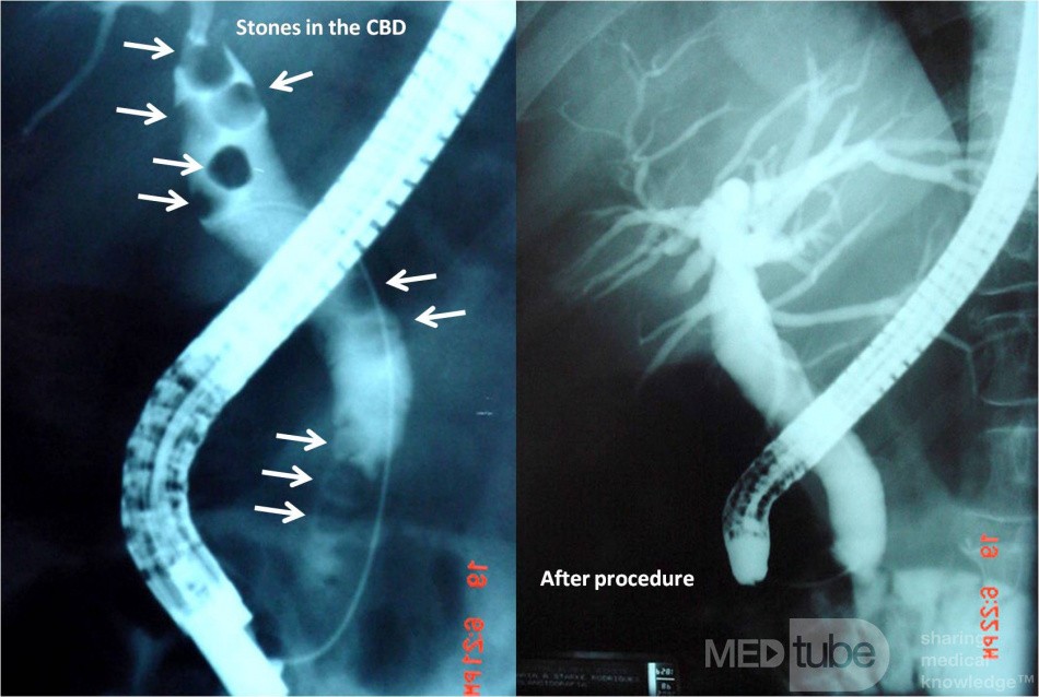 Multiple Stones in the Common Bile Duct