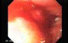 Adenocarcinoma of the Middle Third of Esophagus - Visualization of a Small Nodule in the Upper Third of the Esophagus