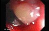 Status Post Rubber Band Ligation for Internal Hemorrhoids (4 of 7)