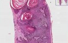 Seborrheic keratosis - Histopathology of skin