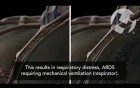 Urosepsis