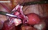 Treatment for Dermoid Cyst - Cystectomy Performed By Laparoscopic Method