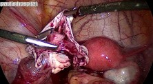 Treatment for Dermoid Cyst - Cystectomy Performed By Laparoscopic Method