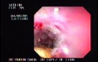 Extensive Ulcerated Carcinoma Of The Descending Colon
