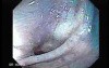 Sigmoid Diverticulitis - Colovesical Fistula (6 of 8)