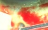 Glaucoma - Plasma Ablation Surgery