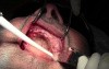 Implant Surgery, #5-6-7-8, 10-11-12-13 Sites