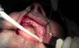 Implant Surgery, #5-6-7-8, 10-11-12-13 Sites