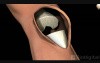 Knee Replacement