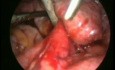 Surgical removal of 