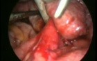 Surgical removal of 