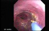 Barrett's Esophagus of long segment (20 of 24)