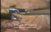 Jejunostomy tube insertion - Laparoscopy