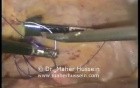 Jejunostomy tube insertion - Laparoscopy