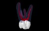 Maxillary Second Molar - 3