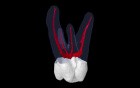 Maxillary Second Molar - 3
