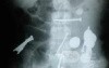 Multiple Foreign bodies in the GI tract (1 of 12)
