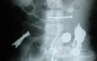 Multiple Foreign bodies in the GI tract (1 of 12)
