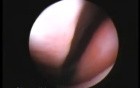 Tonsils: Tubal and Peri-Tubal 