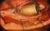 Bullet Removal Surgery Footage