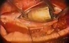 Bullet Removal Surgery Footage