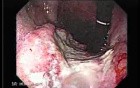 Gastric Adenocarcinoma With Varices - Endoscopy (3 of 8)