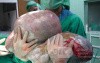 Giant Ovarian Serous Cystadenoma