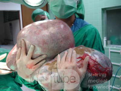 Giant Ovarian Serous Cystadenoma