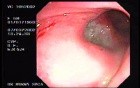 Recto-vaginal Fistula (1 of 3)