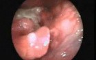 Carcinoma Of Larynx