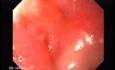 Severe Variceal Bleeding - Blood Aspiration from the Trachea