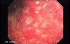 Multiple Rectal Ulcers (9 of 110)